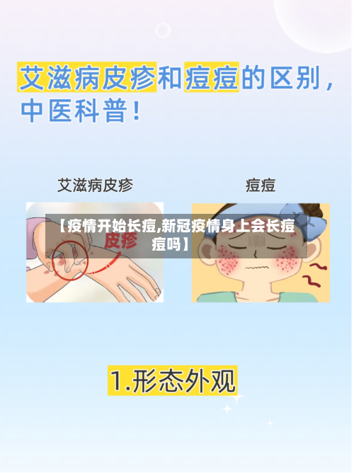 【疫情开始长痘,新冠疫情身上会长痘痘吗】-第2张图片