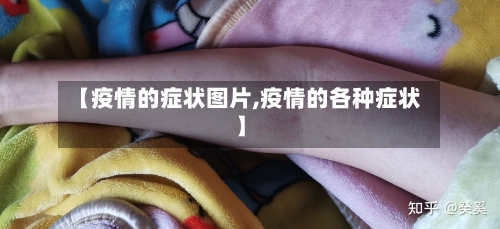 【疫情的症状图片,疫情的各种症状】-第1张图片